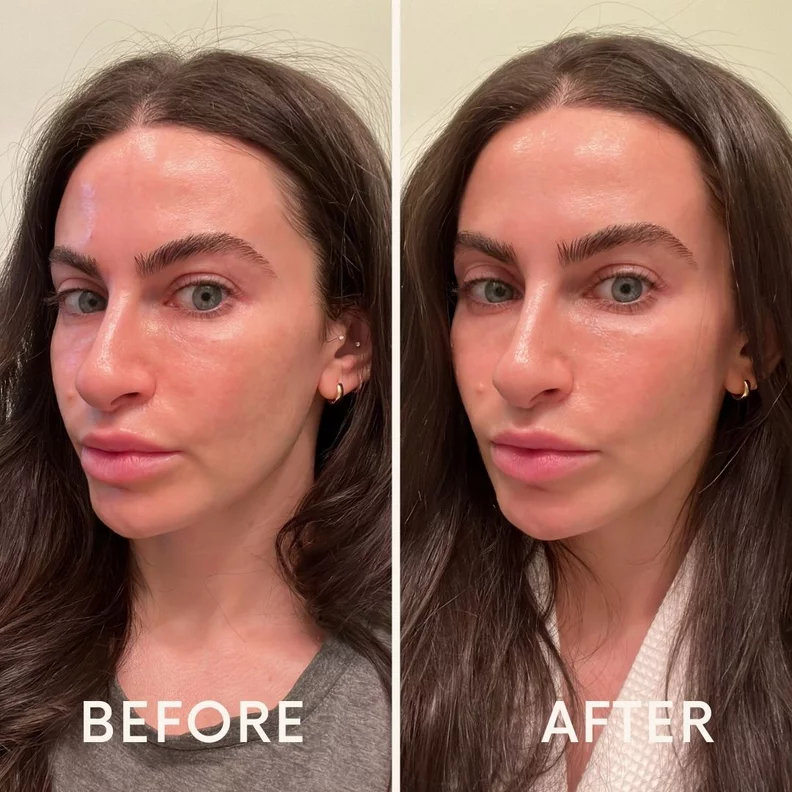 Before and After result F